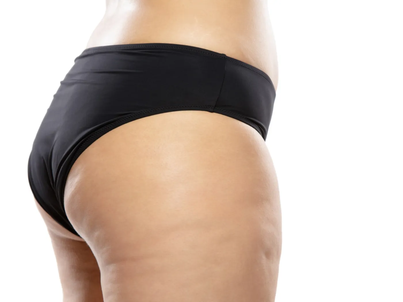 Todo sobre la celulitis: causas y tratamientos